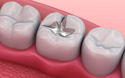 5 Signs You May Need Dental Fillings