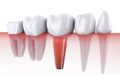 6 Things You Need to Know About Dental Implants